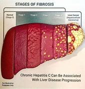 Image result for Liver Fibrosis Scan