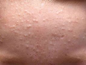 Image result for Dry Skin Bumps On Face