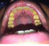 Image result for Talon Cusp Lateral Incisor