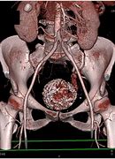 Image result for Uterine Fibroid On CT
