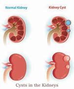 Image result for Cyst On Kidneys Symptoms