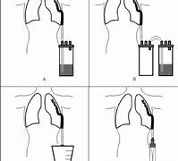 Image result for Closed Chest Tube Drainage System