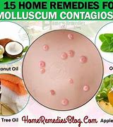 Image result for Natural Molluscum Treatment