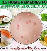 Image result for Molluscum Contagiosum Cure