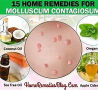 Image result for Molluscum Contagiosum Cure