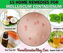 Image result for Molluscum Contagiosum Causes and Treatment