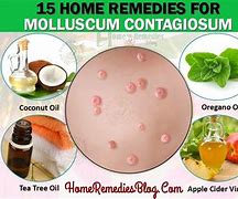 Image result for Molluscum Contagiosum Natural Remedies