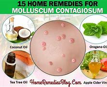 Image result for Molluscum Contagiosum Face Treatment