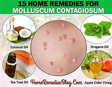 Image result for Molluscum Contagiosum Warts Treatment