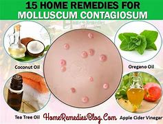 Image result for How Do You Treat Molluscum Contagiosum