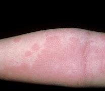 Image result for Red Circle Allergy