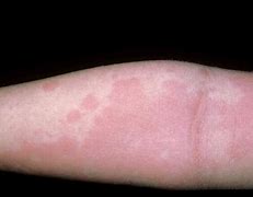 Image result for Food Allergy Symptoms Skin Rash