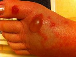 Image result for Bullous Skin Lesions
