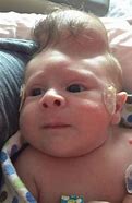 Image result for Baby with Brain Outside Skull