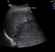 Image result for Hepatic Biliary Cystadenoma Ultrasound