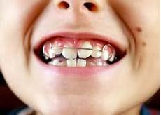 apparecchio mobile apparecchio mobile cemed centro medico dentistico apparecchio mobile apparecchio mobile cemed centro medico dentistico