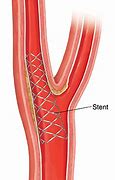 Image result for Carotid Artery Angioplasty with Stenting