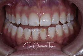 Image result for Peg Lateral Incisors