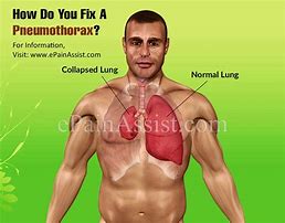 Image result for Collapsed Lung