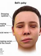 Image result for Signs of Bell's Palsy