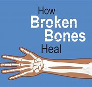 Image result for Fix Broken Bonescartoon