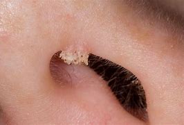 Image result for Filiform Wart On Nose