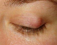 Image result for Cyst On Upper Eyelid