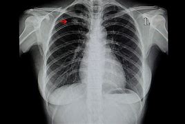 Image result for Pulmonary Nodule ACCP