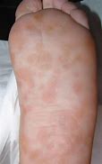 Image result for Syphilis Rash On Foot