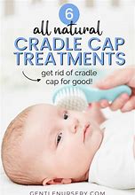 Image result for Cradle Cap Treatment