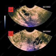 Image result for Cyst On Ovary Ultrasound