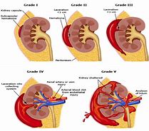 Image result for Renal Lesions On Kidney