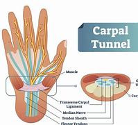Image result for Carpal Tunnel Surgery Recovery Time