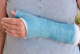 Image result for Bilateral Arm Cast