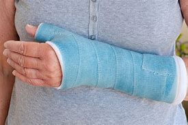 Image result for Broken Arm Plaster Cast