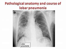 bronchopneumonia 的图像结果