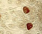 Image result for Granuloma Venereum