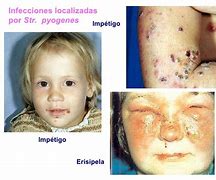 Image result for estreptococia