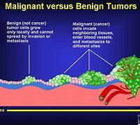 Image result for Benign Tumor Growth