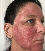 Image result for Chemo Cream for Face