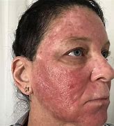 Image result for Topical Chemotherapy