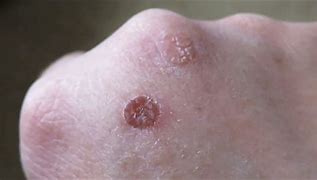Image result for Cryo Wart Removal
