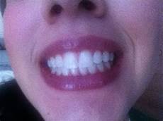 opalescence treswhite supreme opalescence tr 232 swhite supreme tooth whitening home opalescence treswhite supreme opalescence tr 232 swhite supreme tooth whitening home
