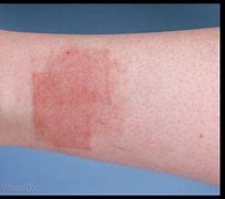 Image result for Rash From Nickel Allergy