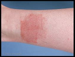 Image result for Nickel Contact Dermatitis