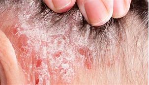Image result for Eczema in Hair