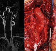 Image result for Aneurysm of Internal Carotid Artery