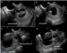 Image result for Anencephaly in Ultrasound