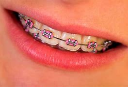 Image result for Braces with Pink Bands