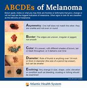 Image result for Melanoma Cells Photo in Body